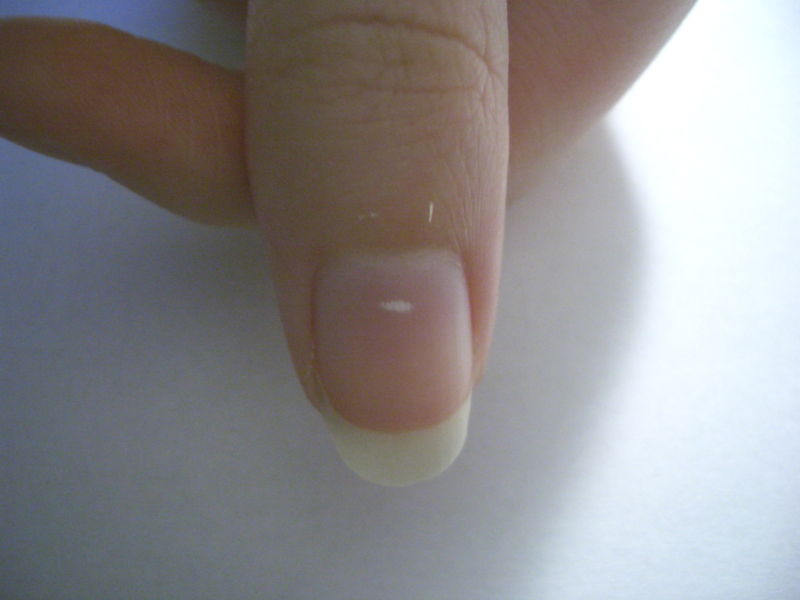 The majority of white spots on fingernails are caused by a previous injury